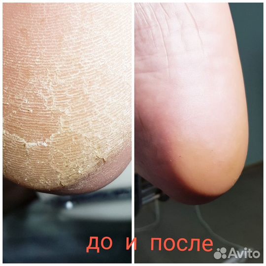 Подолог, медицинский педикюр маникюр