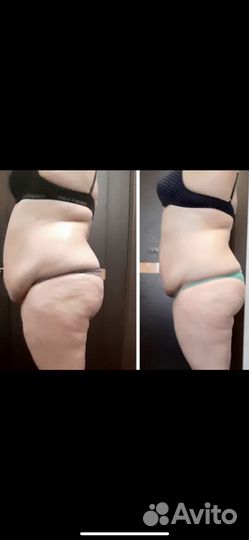 Аппаратный массаж