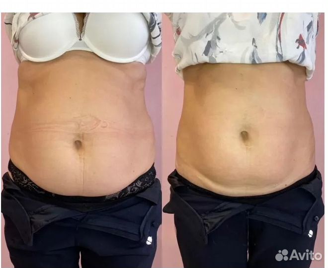 Липосакция без операции в Воронеже