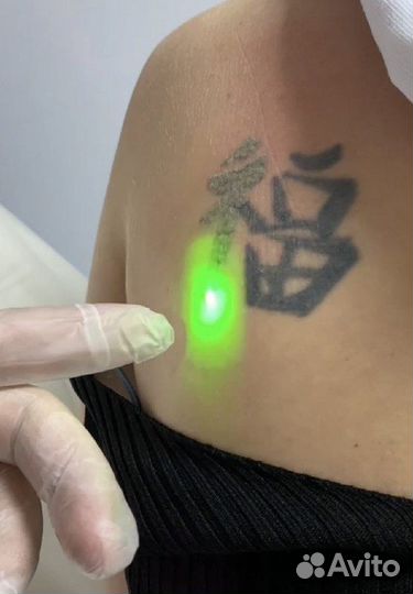 Удаление тату и татуажа. Карбоновый пилинг