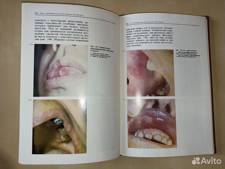 Атлас заболеваний слизистой оболочки полости рта