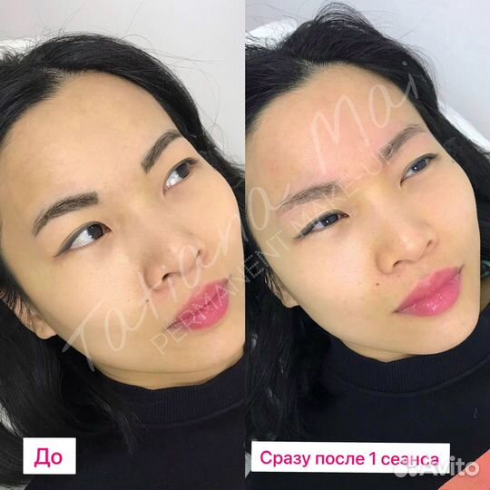 Удаление лазером татуажа и тату