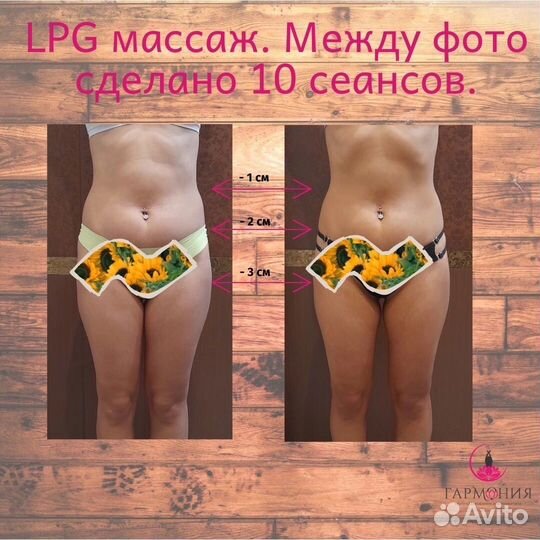 Массаж LPG