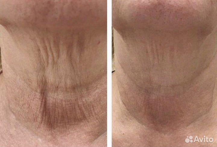 Лечение угревой сыпи