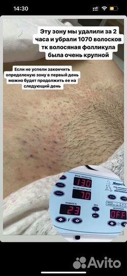 Электроэпиляция