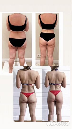 Эндосфера массаж, похудение