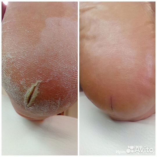 Педикюр. Подология