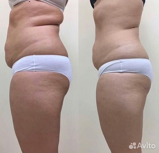 Супер коррекция фигуры УЗ Кавитация+ РФ Лифтинг