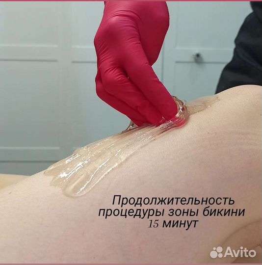 Лазерная эпиляция