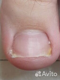 Вросший ноготь. Установка коррекционной системы