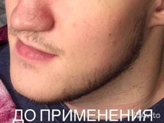 Миноксидил