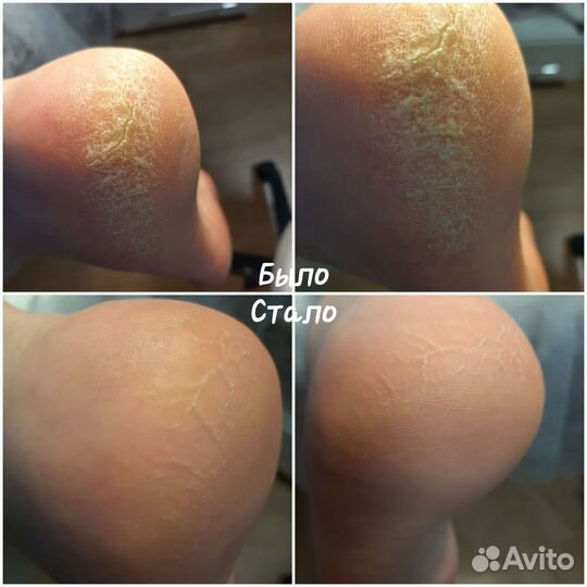 Педикюр на Вые