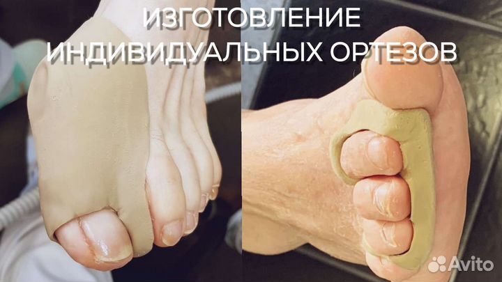 Педикюр подолог