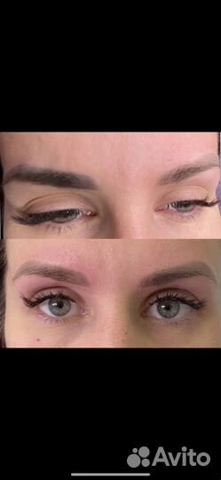 Удаление тату и татуажа лазером