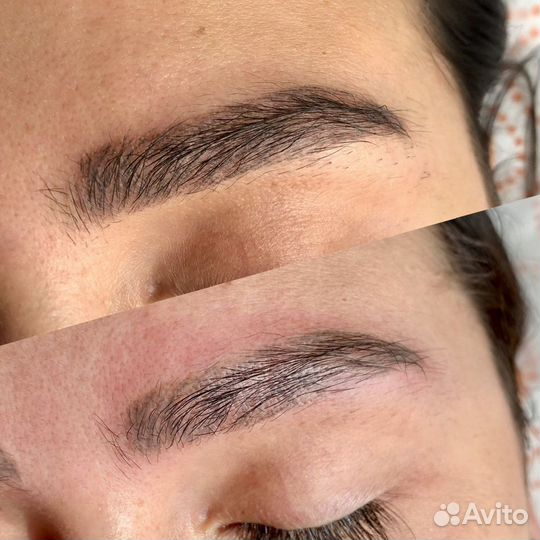 Удаление тату/татуажа