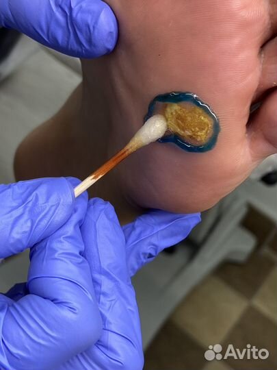 Подолог. Лечебный педикюр. Без боли