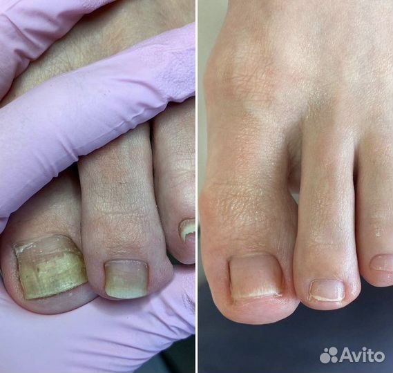 Медицинский педикюр подолог титановая нить