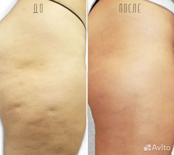 Аппаратный массаж по коррекции фигуры