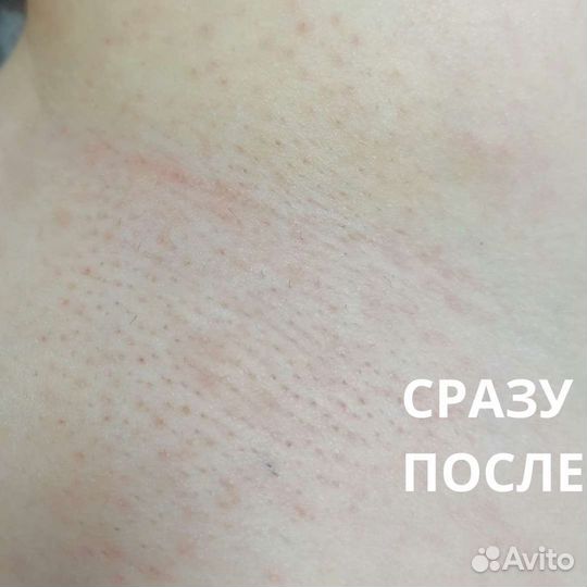 Электроэпиляция