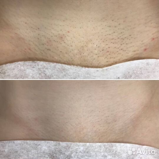 Лазерная эпиляция в Воронеже