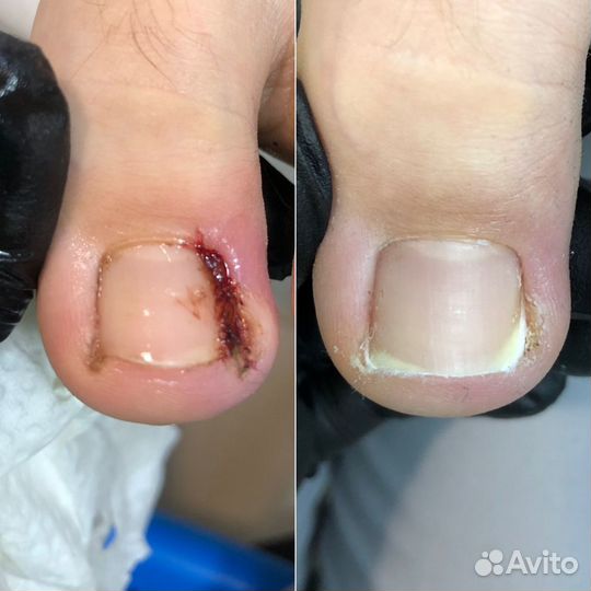 Педикюр Подолог Вросший ноготь Ростов