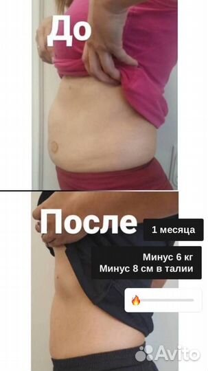 Бионити, коррекция фигуры, похудение, кетгут