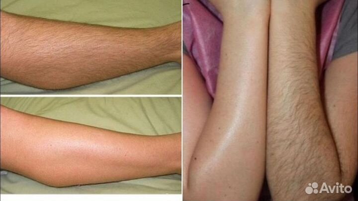 Лазерная эпиляция. Первая процедура в подарок