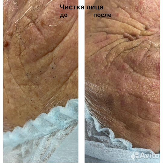 Дарсонвализация