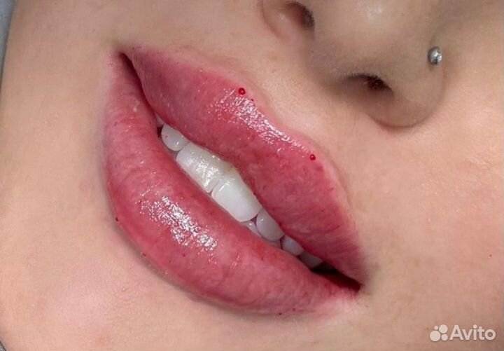Увеличение губ