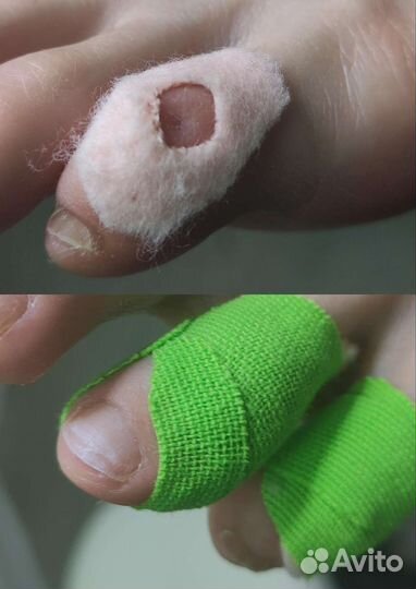 Лечебный педикюр подолог