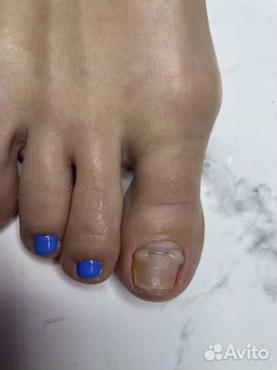 Педикюр подолог