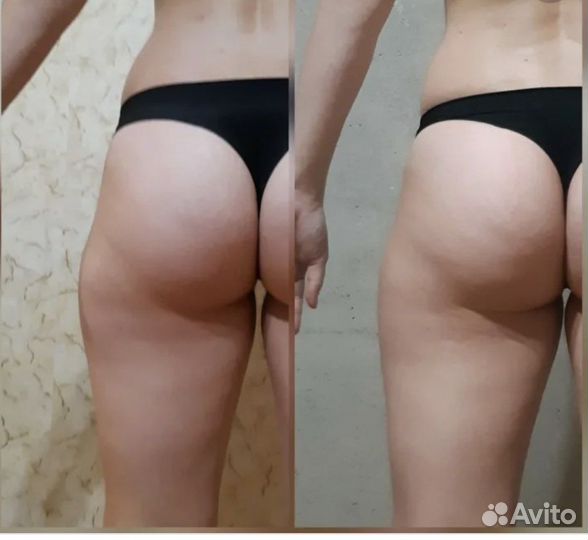 Антицелюлитный Массаж New на аппарате Turbo G 8