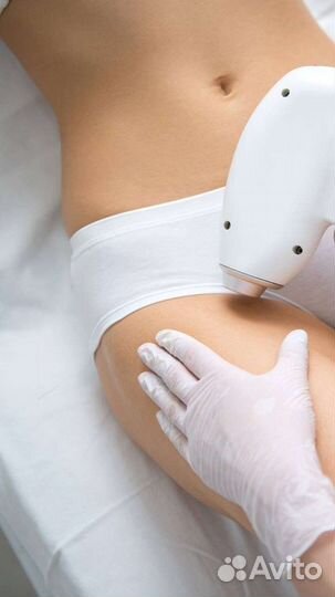 Лазерная эпиляция