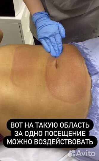 Криолиполиз тело/подбородок