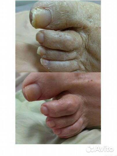 Аппаратный педикюр, выезд на дом, подолог