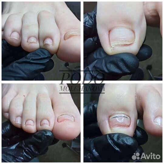 Подолог. Работа с проблемами стопы. Вросший ноготь