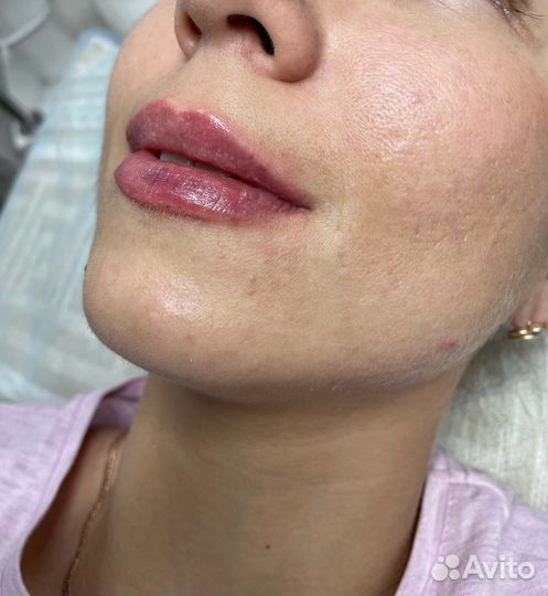 Увеличение губ