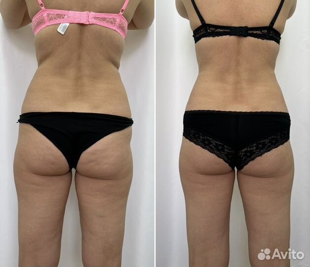 Lpg–массаж, ручной массаж