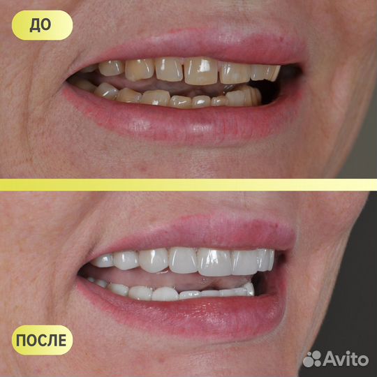 Виниры и коронки на зубы