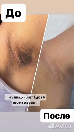 Для отбеливания интимных зон