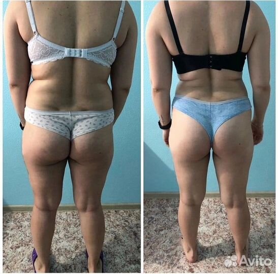 Аппаратная коррекция фигуры. Плоский живот