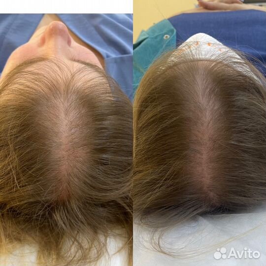 Услуги косметолога / Холодная плазма