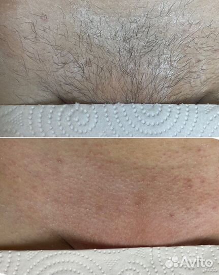 Восковая депиляция