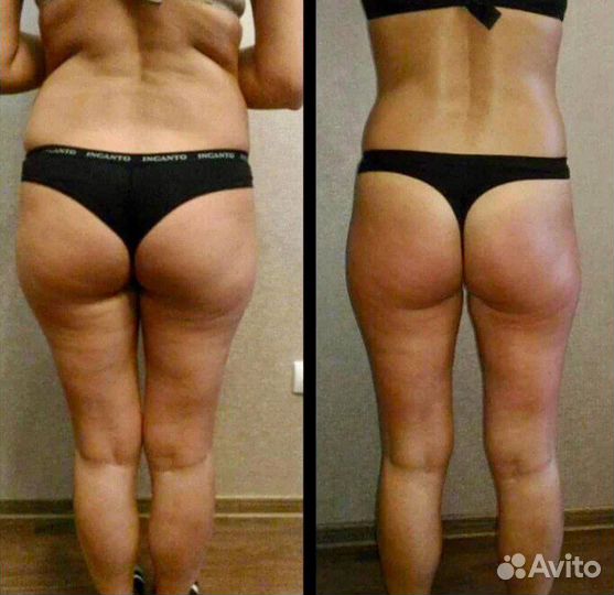 Эндосфера терапия