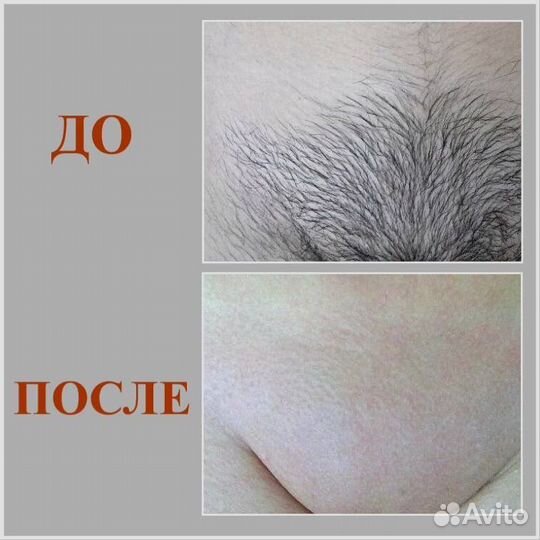 Гладкое бикини за 20мин Шугаринг/воск