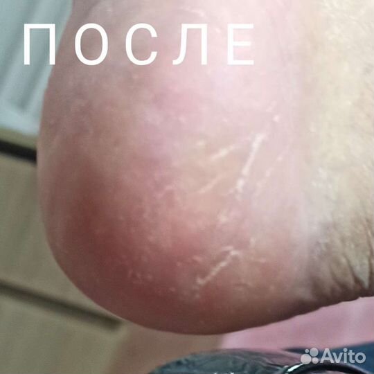 Маникюр Педикюр Деформация ногтей Мозоли Трещины