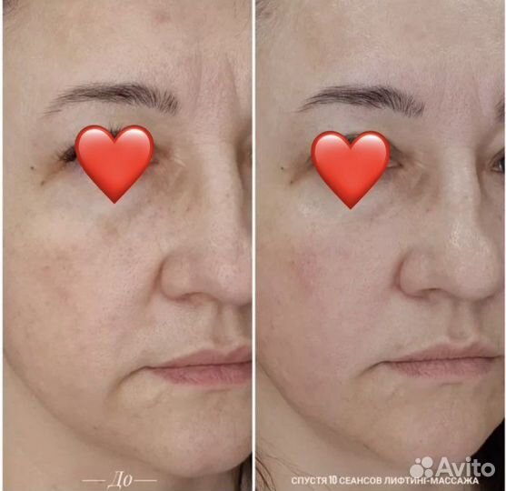 Антицеллюлитный массаж