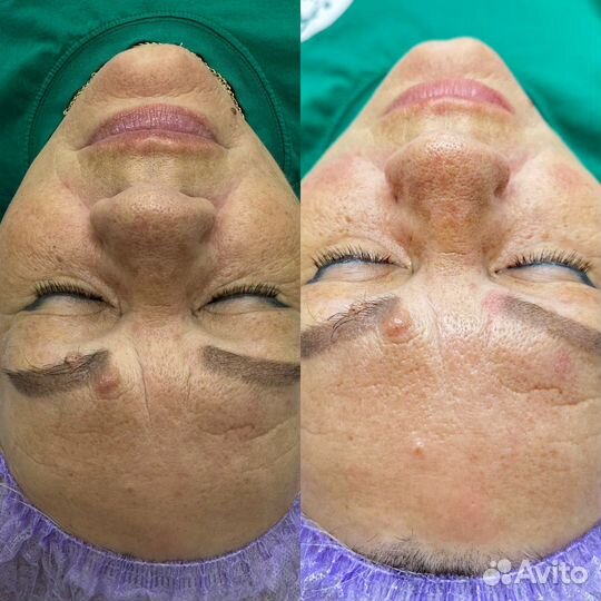 Плазмолифтинг