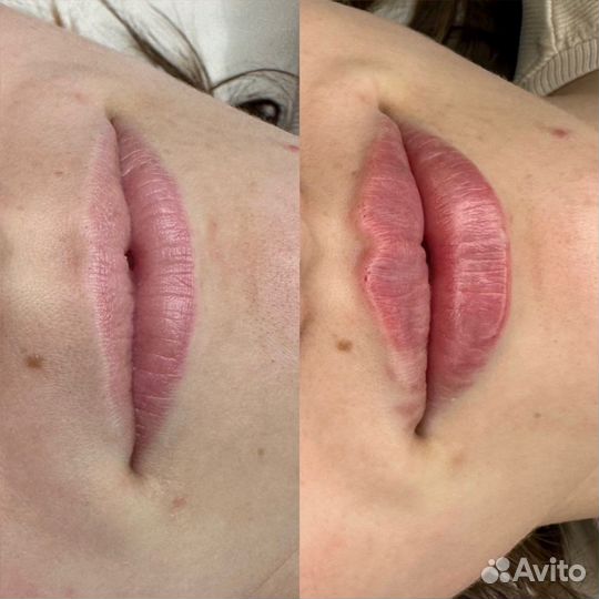 Увеличение губ