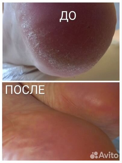 Полология. Ортониксия. Титановая нить